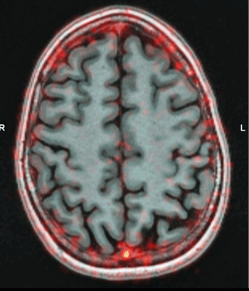 White blood cell tracing in the brain