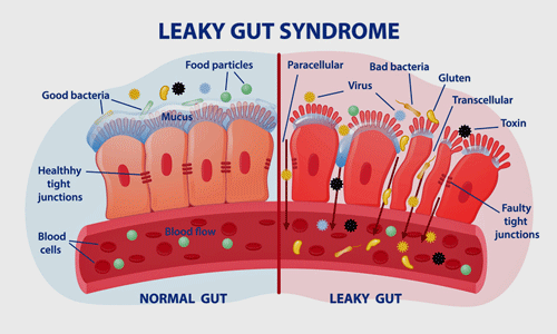 Leaky gut syndrome