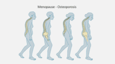 Menopause and osteoporosis