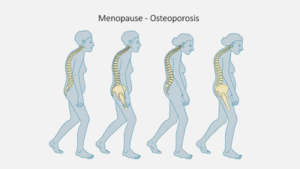 Menopause and osteoporosis