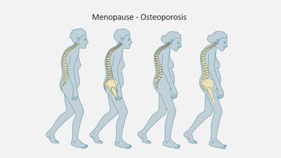 Osteoporosis: The Fibromyalgia (and ME/CFS and Long COVID?) Connection