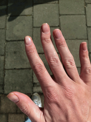 Ussher fingernails after apheresis