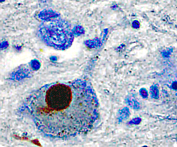 Alpha synuclein protein in Lewy body dementia