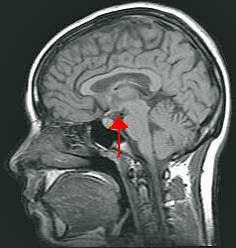 The small hypothalamus plays an important role in the hypovolemic thirst center. 