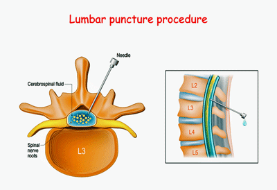 lumbar puncture