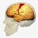 The Nath ME/CFS Intramural Study Pt. I: It’s a Brain Disease…