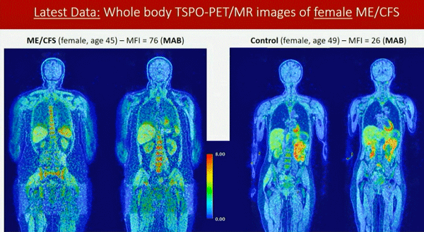 Full body PET scans