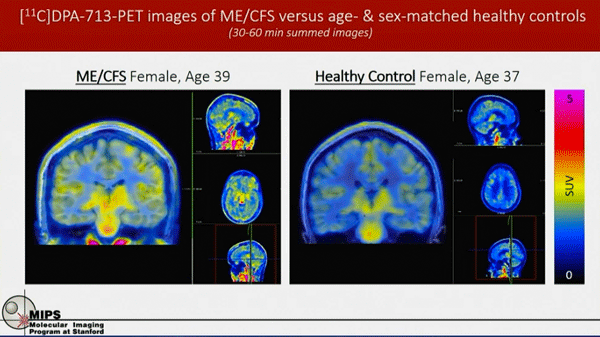 Pet Scan