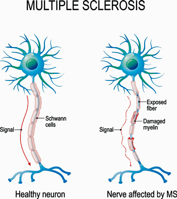 Demyelination MS