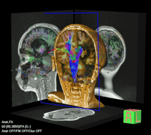 Diffusion tensor scan