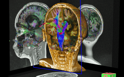 Diffusion tensor scan