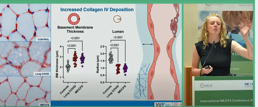 Slaghekke basement membranes ME/CFS