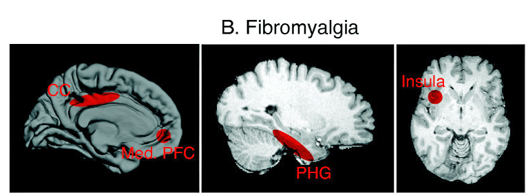 structural changes brain fibromyalgia