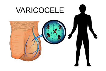 Variococeles