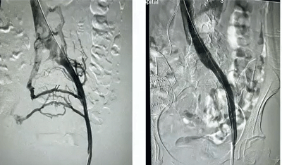 Collateral veins disappear after a stent