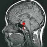 hypothalamus