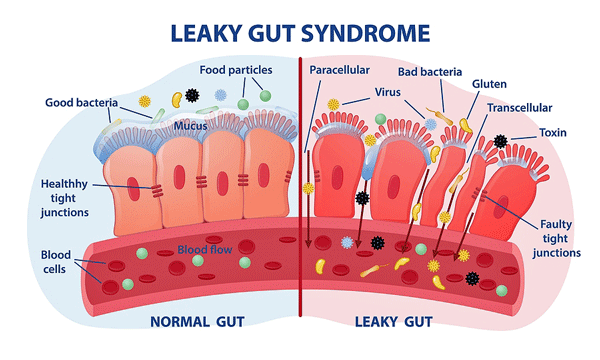leaky gut syndrome