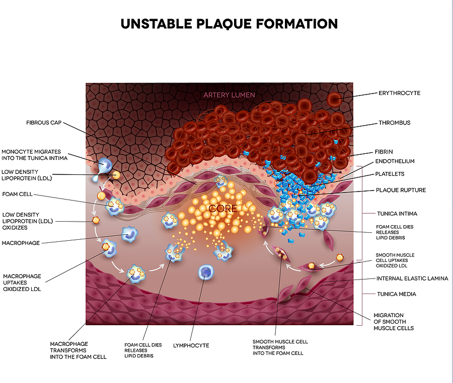 arterial plaques
