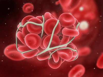 blood clot - bigstock