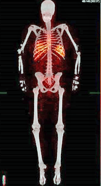 T-leukocyte tracking